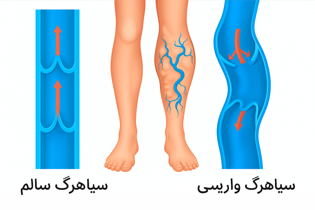 علت علمی بیماری واریس