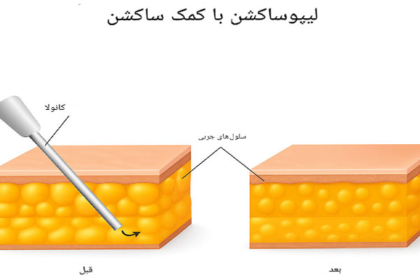 جراحی لیپوساکشن