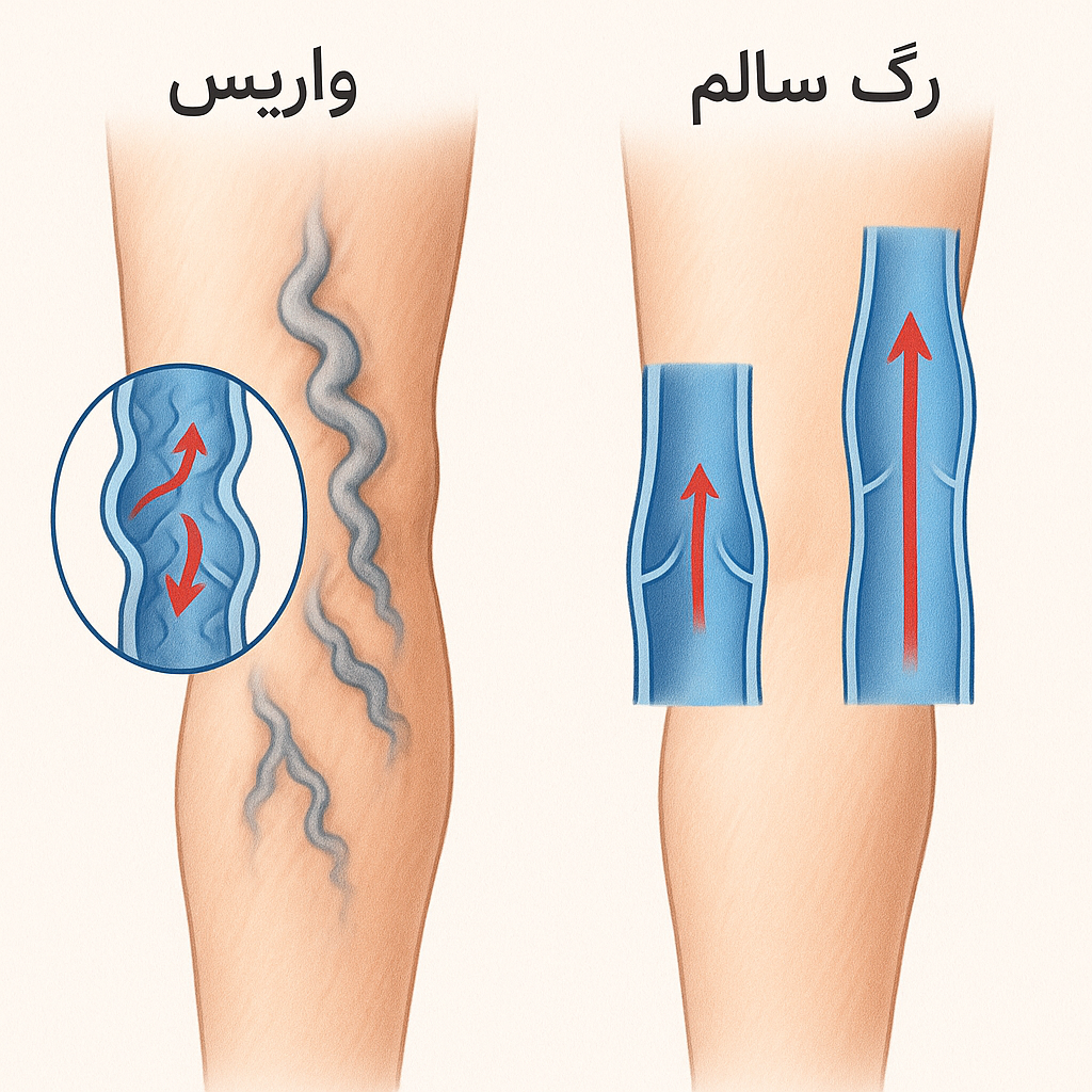 تفاوت واریس پا و سلامت پا
