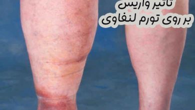 تاثیر واریس بر روی تورم لنفاوی