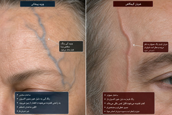 دلایل-بیرون-زدگی-رگ-پیشانی دلایل بیرون زدگی رگ پیشانی