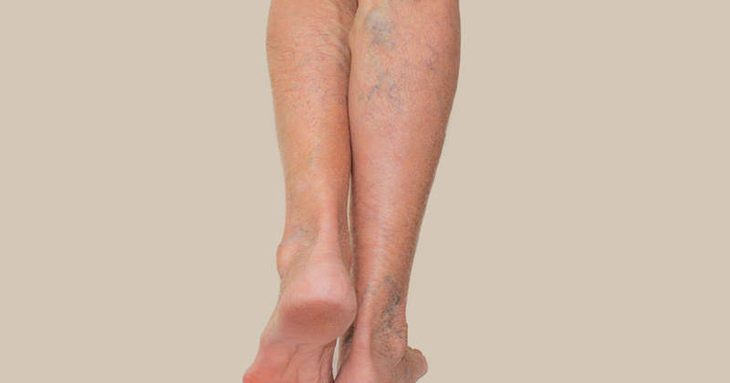 سلامت عروق در بارداری