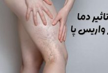 واریس پا