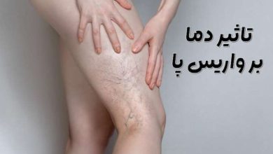 واریس پا