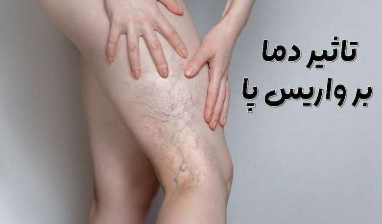 واریس پا