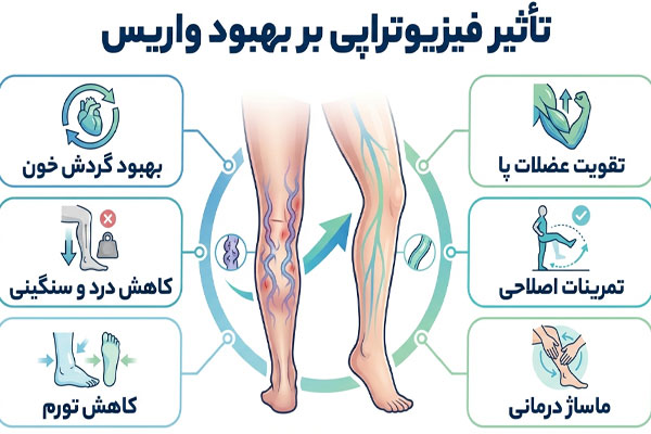 بهبود واریس با فیزیوتراپی