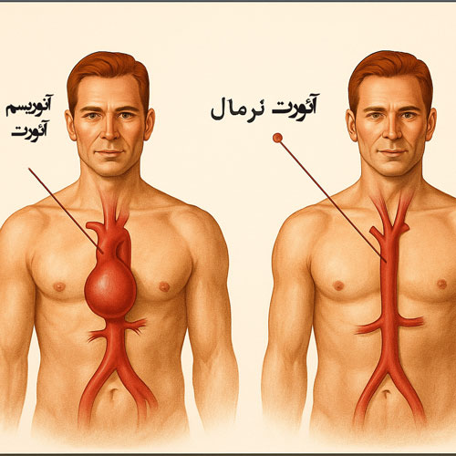آنوریسم آئورت 