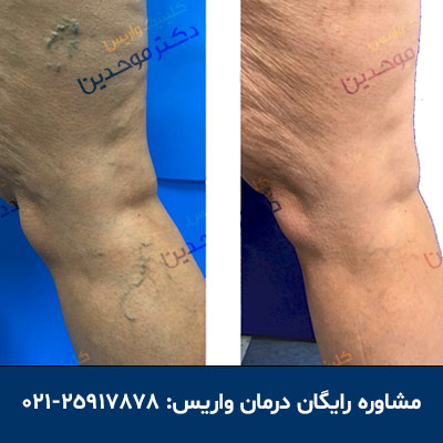 درمان تضمینی واریس پا توسط متخصص واریس پا در تهران