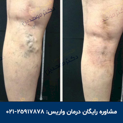درمان واریس در کلینیک واریس در تهران