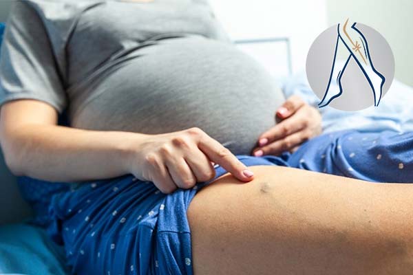 علت واریس در بارداری چیست؟