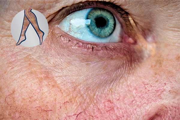 درمان واریس بینی و دور چشم 