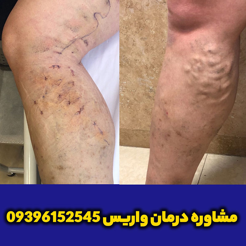 اسکلروتراپی (Sclerotherapy): تزریق برای بستن عروق واریسی