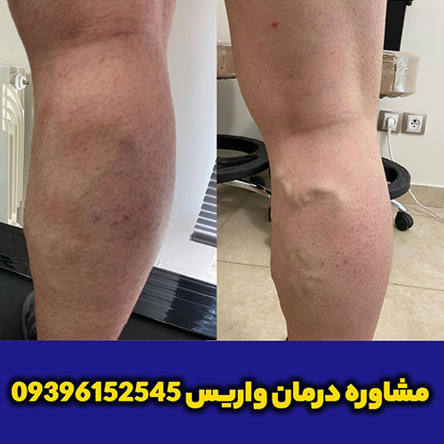 علت شکل گیری واریس چیست ؟