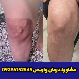 درمان-واریس