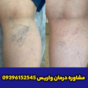 نمونه-درمانی-واریس