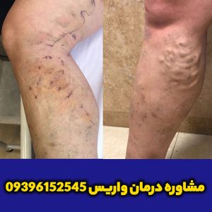 واریس-درمان