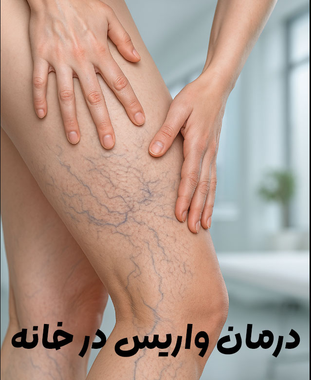 درمان خانگی واریس