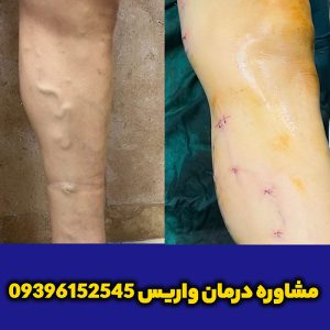 واریس-درمانی